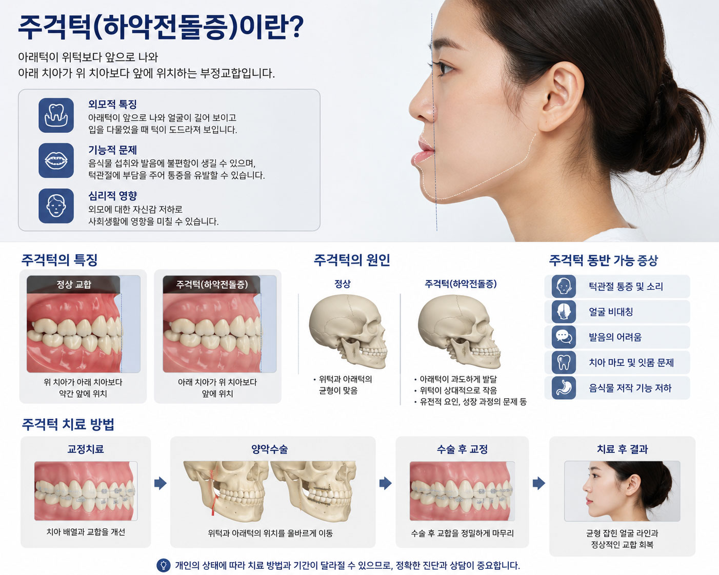 천안 아산 주걱턱 교정 반대교합 아래턱 돌출 설명 연세발렌타인치과교정과