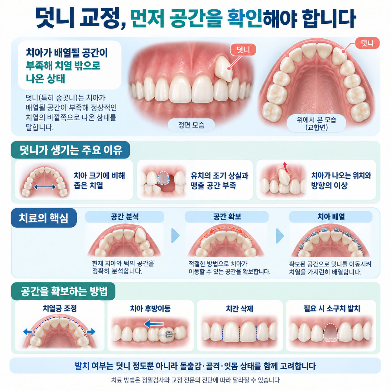 천안 아산 덧니 교정 덧니 생기는 이유 공간 부족 설명 연세발렌타인치과교정과